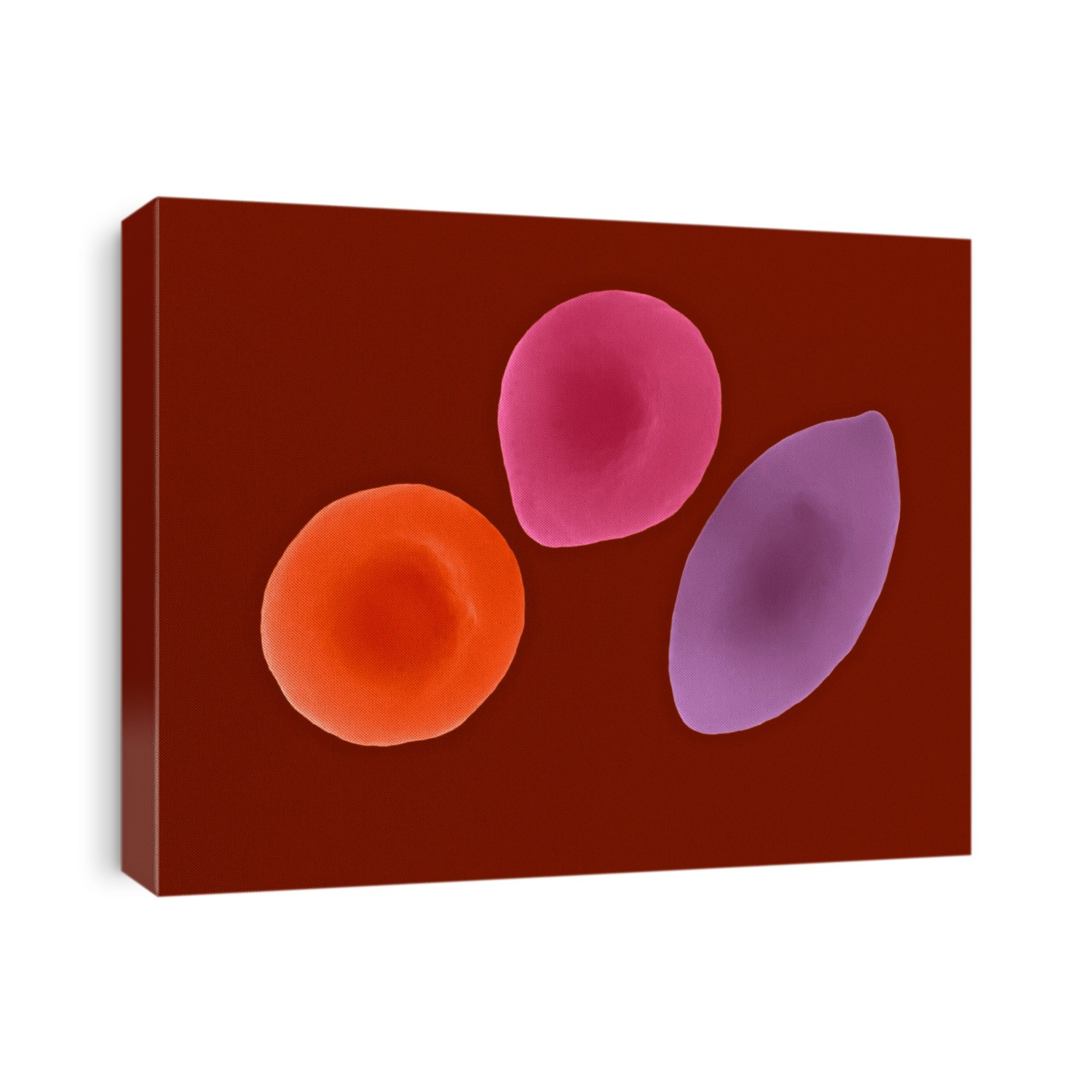 Healthy, intermediate and sickle human red blood cells (oblong, tapered cells), coloured scanning electron micrograph (SEM). Sickle-cell anaemia (SCA) is a hereditary blood disorder, where red blood cells develop an abnormal sickle-shaped morphology. This change in shape decreases the cell's flexibility and results in life-threatening complications. Because of a mutation in the haemoglobin gene individuals with 1 copy of the mutant gene produce a mixture of both normal and abnormal haemoglobin containing red blood cells. Sickle-cell anaemia is a form of sickle-cell disease in which there is homozygosity for the mutation. Magnification: x1,200 when shortest axis printed at 25 millimetres.