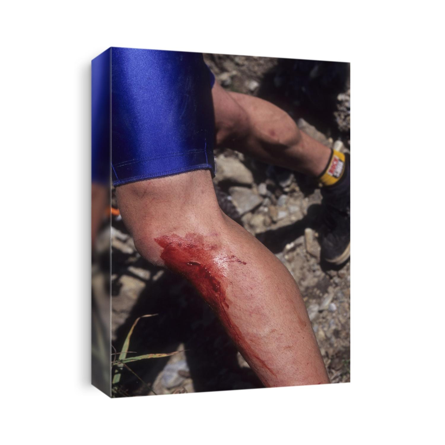 Injured mountain bicycllist.